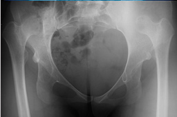 Acetabular dysplasia, hip dysplasia human