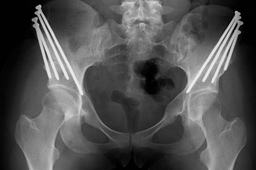 Bilateral periacetabular osteotomies (PAO surgery)