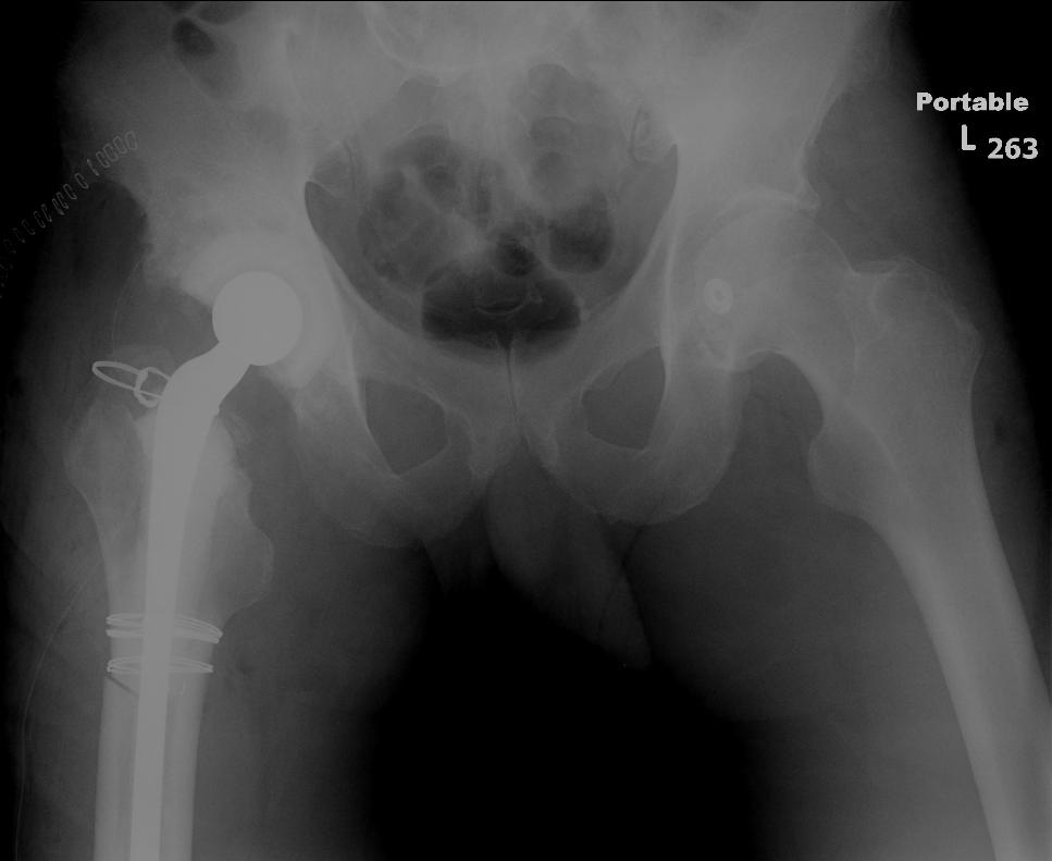 Antibiotic Spacer Revision total hip replacement in a 59 year old male with infection