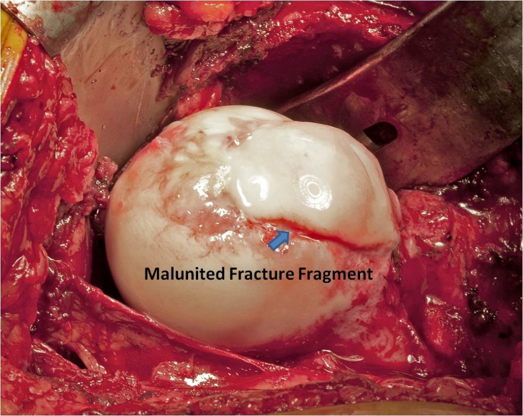 Intraop Surgical dislocation for FAI after femoral head fracture malunion in an active young male