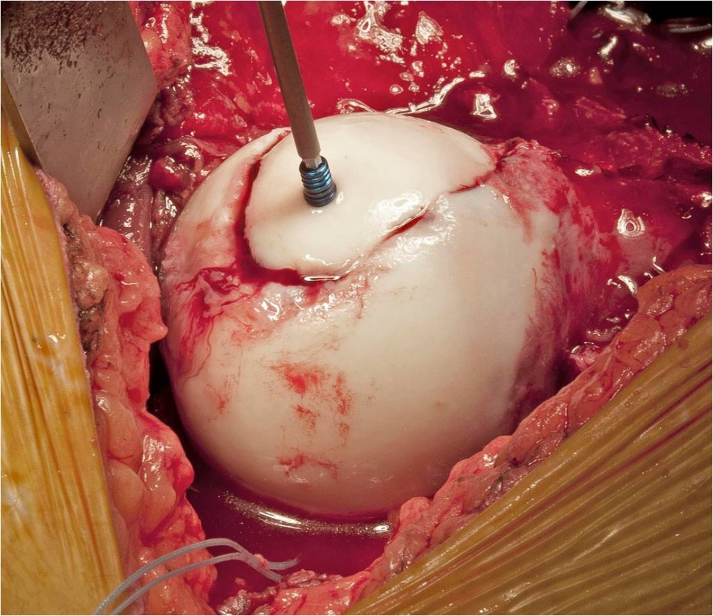 Intraop Surgical dislocation for FAI after femoral head fracture malunion in an active young male
