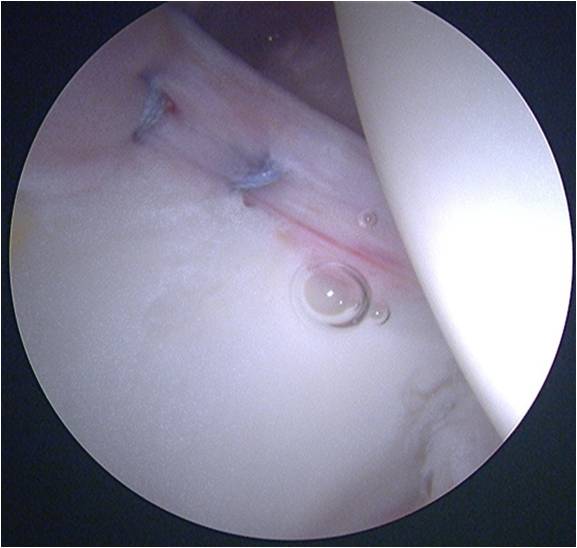Labral Repair Hip arthroscopy for treatment of an acetabular labral tear in a female dancer