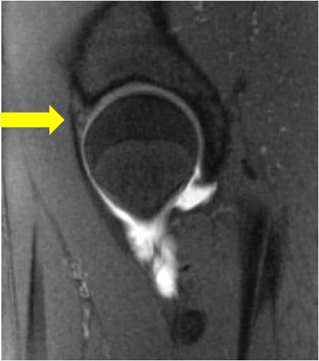 Labral Tear Proximal femoral osteotomy and hip arthroscopy to treat mild hip dysplasia in a 14 year old female skater