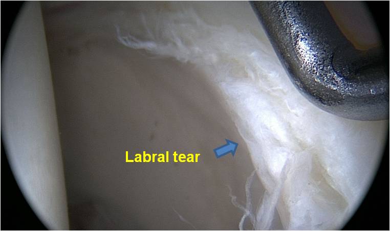 Labral Tear Picture Hip arthroscopy for an 18 year old male baseball player with FAI