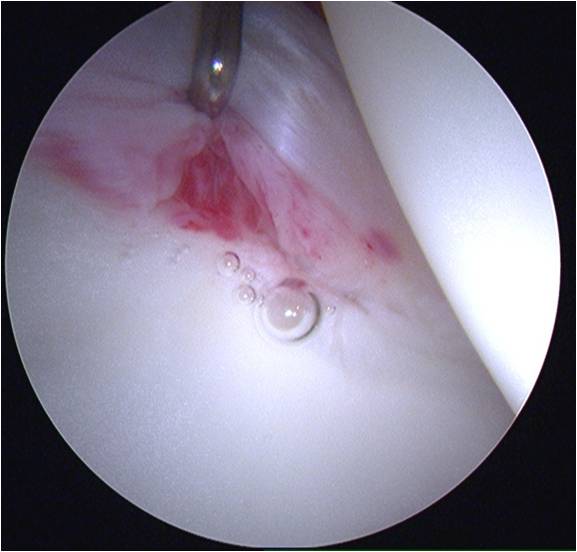 Labral tear Hip arthroscopy for treatment of an acetabular labral tear in a female dancer