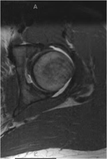 MR1 Hip arthroscopy in an 18 year old hockey goalie with femoracetabular impingement and labral tear