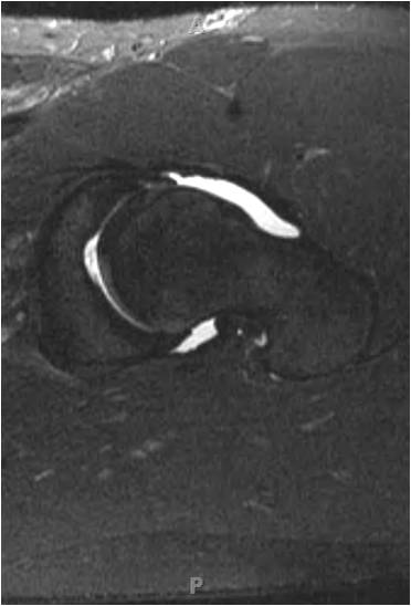 MR2 Hip arthroscopy in an 18 year old hockey goalie with femoracetabular impingement and labral tear