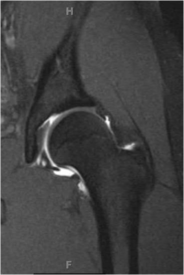 MR3 Hip arthroscopy in an 18 year old hockey goalie with femoracetabular impingement and labral tear