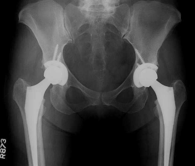 Post AP 2 yr Total hip replacement in a middle-aged female patient with bilateral hip osteoarthritis
