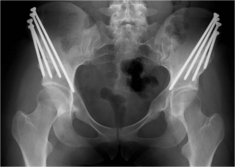 Post OP Pre OP PAO in young female patient with hip dysplasia