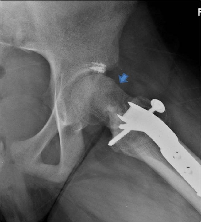 Post OP Surgical dislocation and proximal femoral osteotomy for a 12 year old female with pain after slipped capital femoral epiphysis (SCFE)