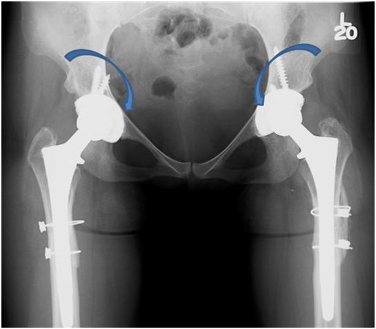 Post OP AP with arrows Pre OP AP with arrows Pre OP AP Complex total hip replacement for a 20 year old female with congenital hip dislocations