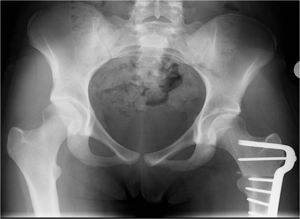 Post OP AP Proximal femoral osteotomy and hip arthroscopy to treat mild hip dysplasia in a 14 year old female skater