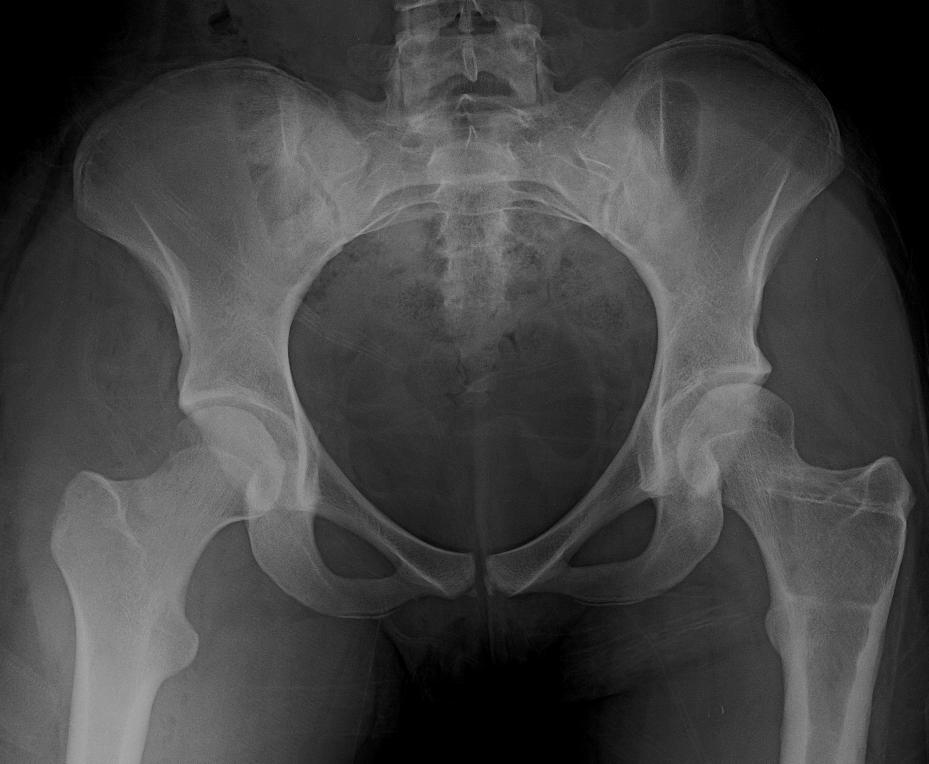 Post OP AP Proximal femoral osteotomy and hip arthroscopy to treat mild hip dysplasia in a 14 year old female skater