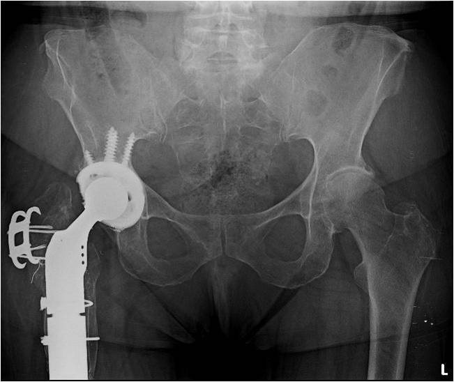 Post op AP Revision hip replacement for treatment of chronic infection and periprosthetic fracture in a middle-aged female patient