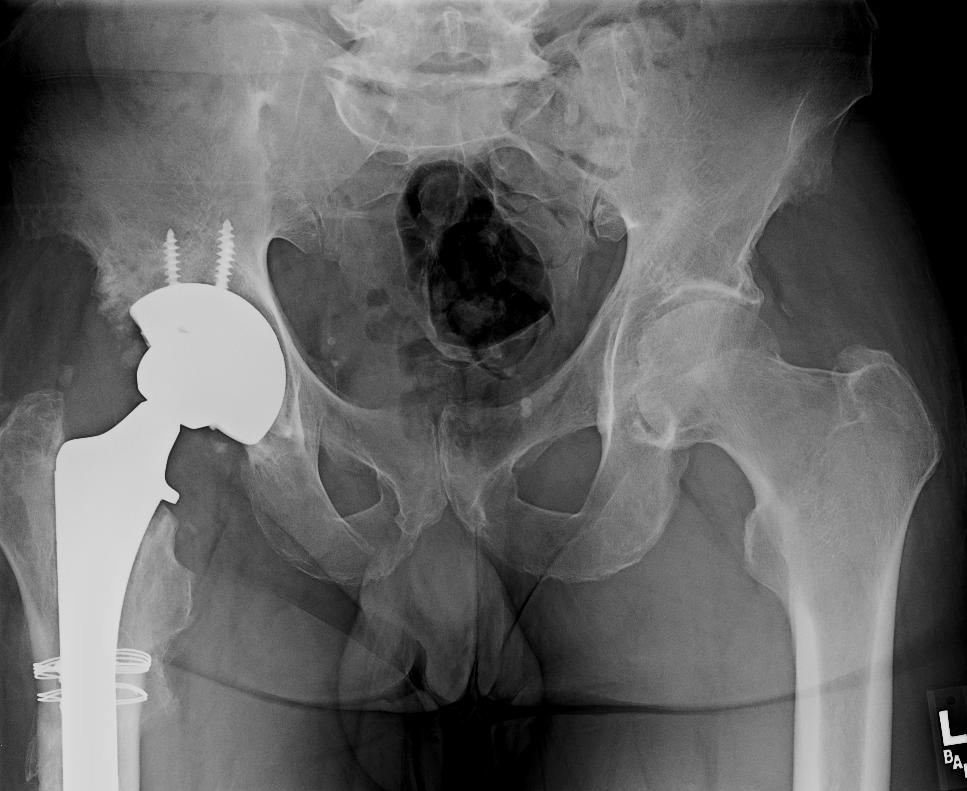 Post OP AP Revision total hip replacement in a 59 year old male with infection