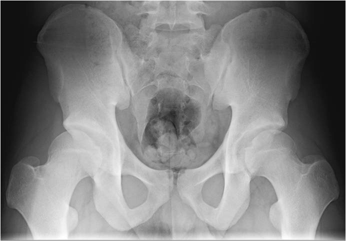 Post OP AP Hip arthroscopy in an 18 year old hockey goalie with femoracetabular impingement and labral tear