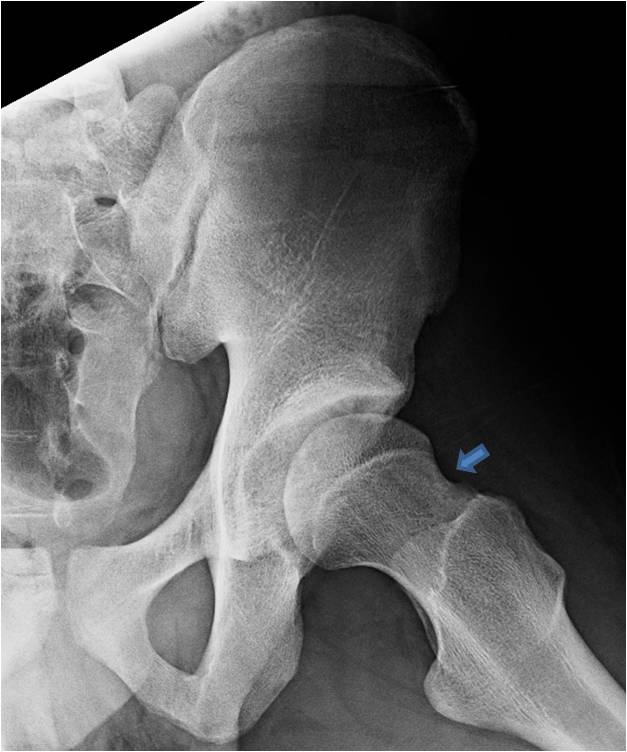 Post OP Frog Hip arthroscopy in an 18 year old hockey goalie with femoracetabular impingement and labral tear