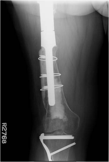Post op AP Hip Revision hip replacement for treatment of chronic infection and periprosthetic fracture in a middle-aged female patient