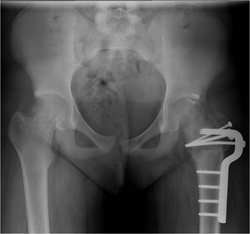 Post OP Surgical dislocation and proximal femoral osteotomy for a 12 year old female with pain after slipped capital femoral epiphysis (SCFE)