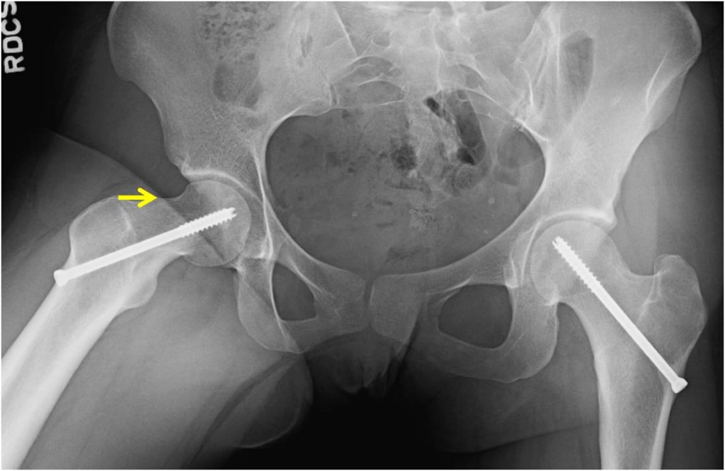 Post OP Hip arthroscopy for treatment of a mild slipped capital femoral epiphysis (SCFE) deformity in a 22 year old female patient