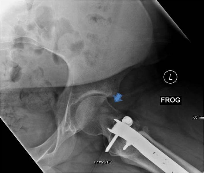 Post OP Surgical dislocation and proximal femoral osteotomy in an 18 year old male with severe residual SCFE deformity
