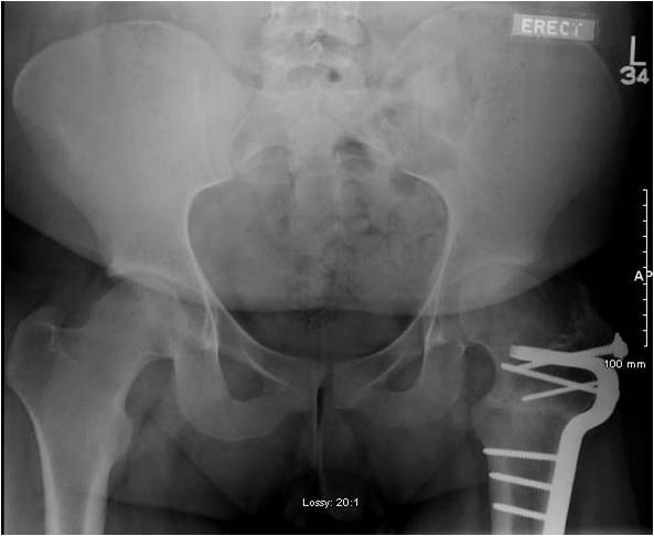Pre OP Surgical dislocation and proximal femoral osteotomy in an 18 year old male with severe residual SCFE deformity
