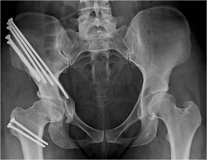 Post OP AP PAO and surgical dislocation for a “Perthes” deformity in a 29 year old female