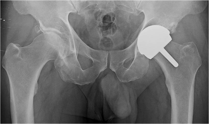 Post OP Total hip resurfacing for an active 60 year old