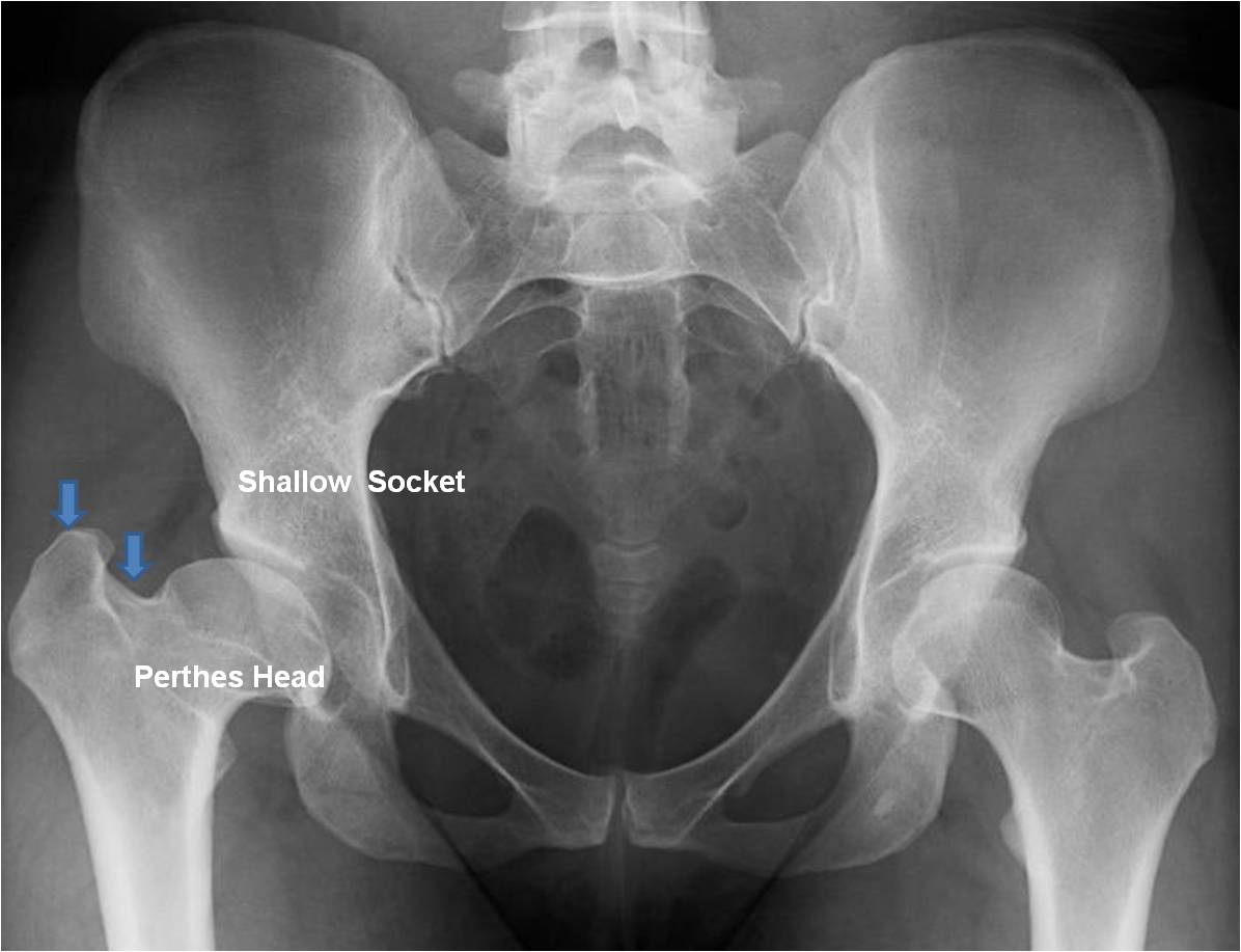 Pao And Surgical Dislocation For A “perthes” Deformity In A 29 Year Old