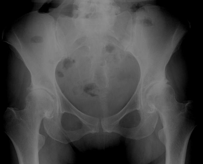 Pre AP Total hip replacement in a middle-aged female patient with bilateral hip osteoarthritis