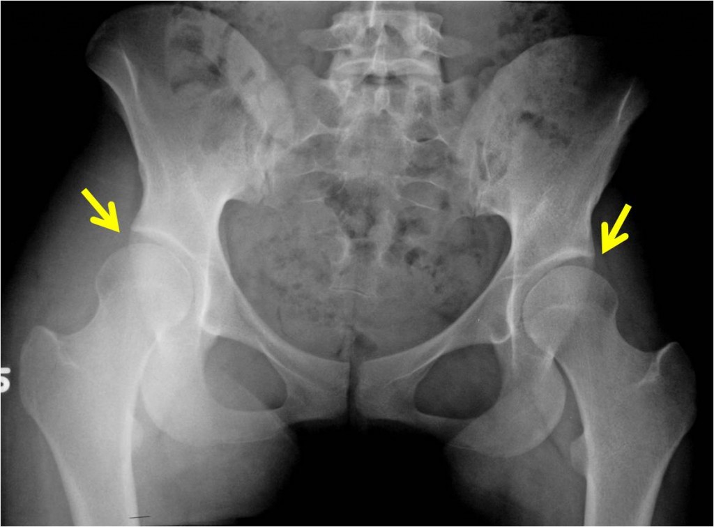 Pre OP PAO in young female patient with hip dysplasia