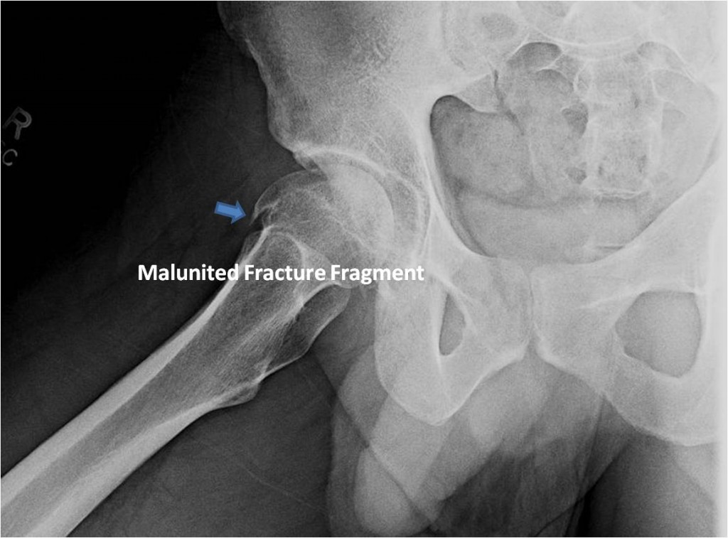 Pre OP Surgical dislocation for FAI after femoral head fracture malunion in an active young male