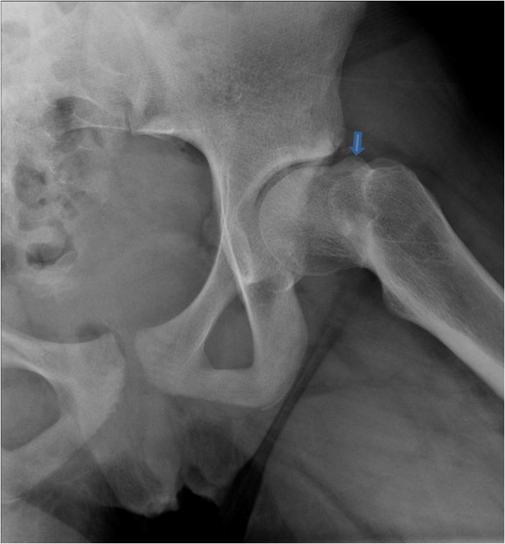 Pre Op Surgical dislocation and proximal femoral osteotomy for a 12 year old female with pain after slipped capital femoral epiphysis (SCFE)