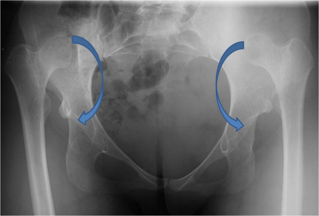 Pre OP AP with arrows Pre OP AP Complex total hip replacement for a 20 year old female with congenital hip dislocations