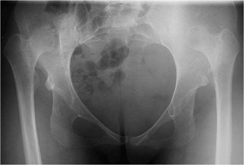 Pre OP AP Complex total hip replacement for a 20 year old female with congenital hip dislocations