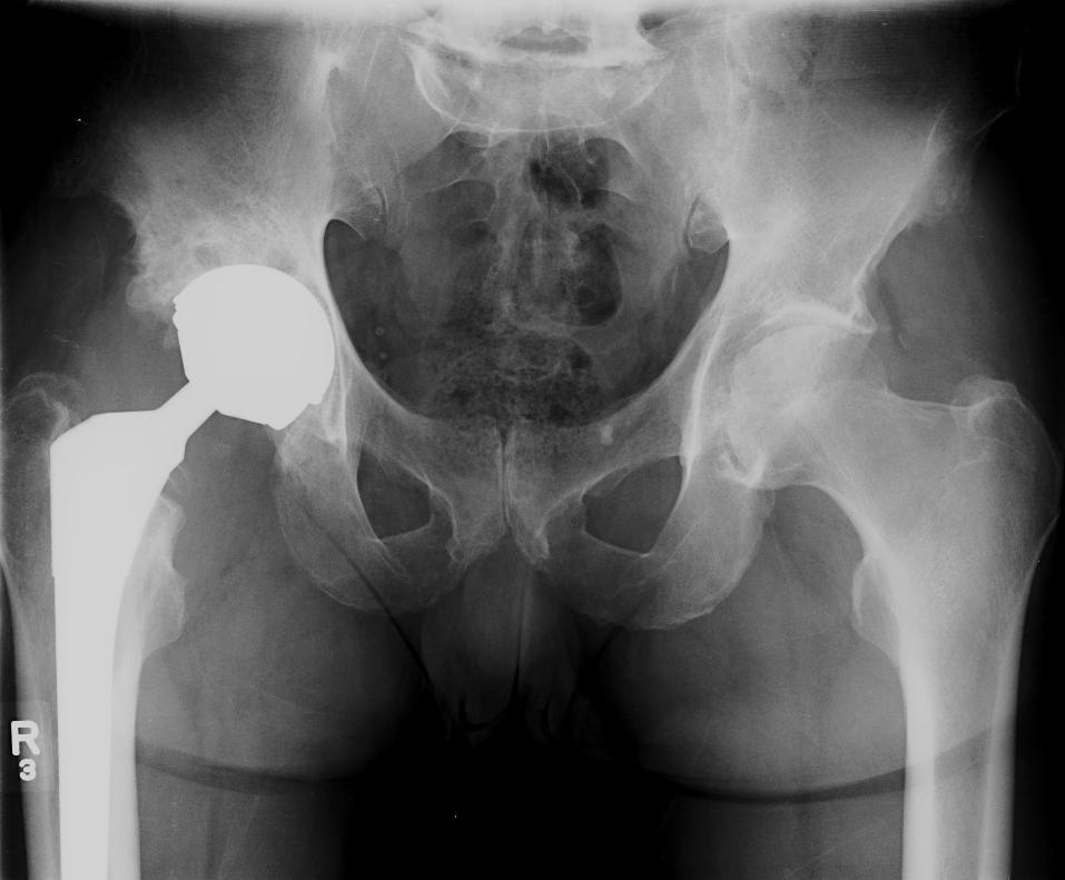 Pre OP AP Revision total hip replacement in a 59 year old male with infection