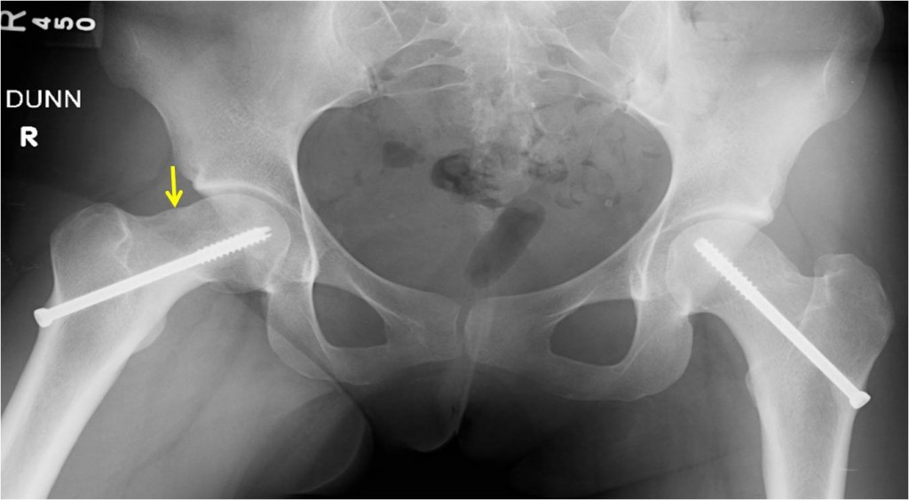 Pre OP Hip arthroscopy for treatment of a mild slipped capital femoral epiphysis (SCFE) deformity in a 22 year old female patient