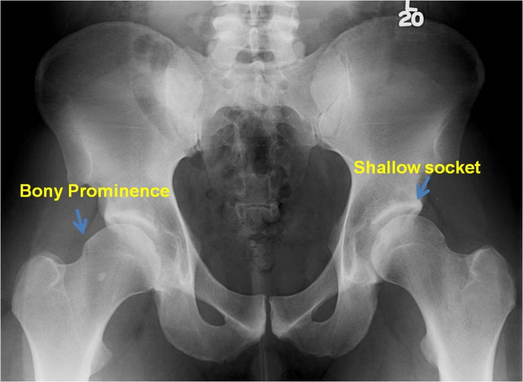 Pre Op 1 PAO for hip dysplasia in an active 25 year old male