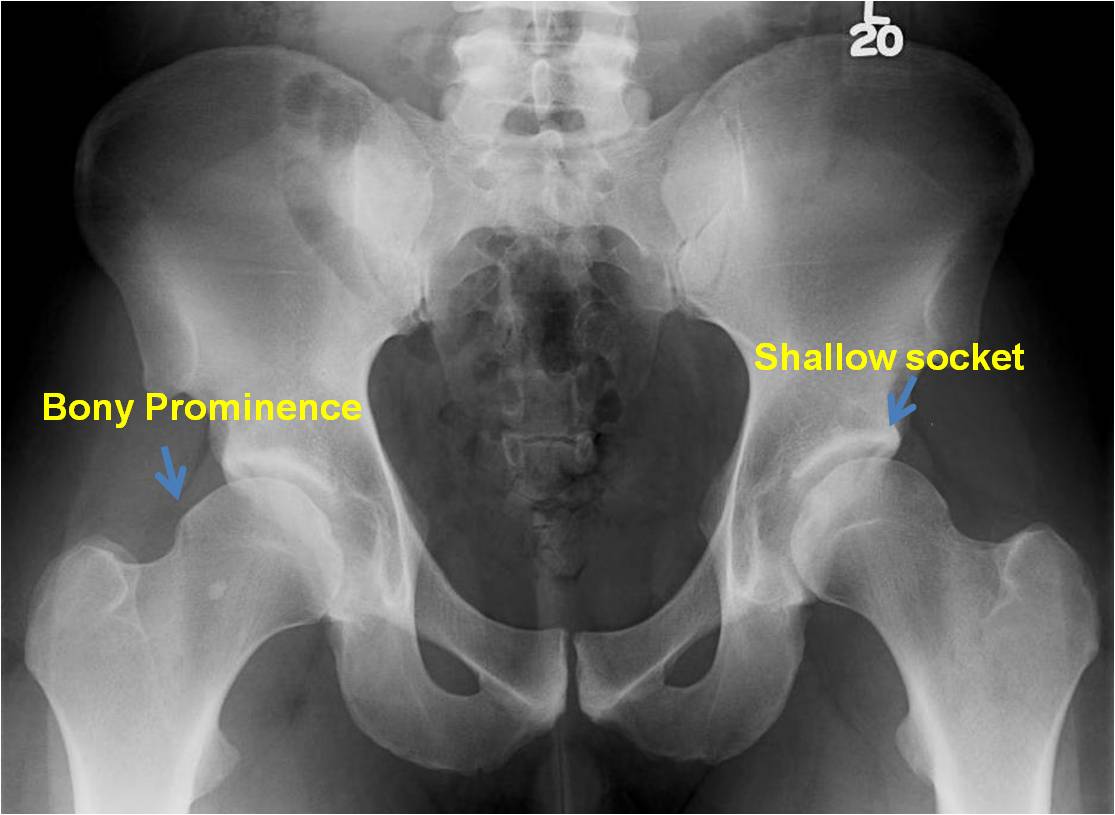 Pao Surgery In Young Female Patient With Hip Dysplasia St Louis Hip Surgeon John C Clohisy 7944