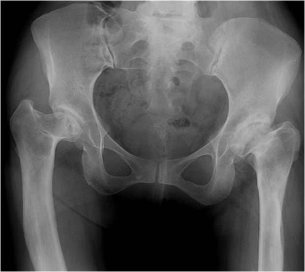 Pre op ap Complex total hip replacement in a young adult female with previous hip osteotomy surgery