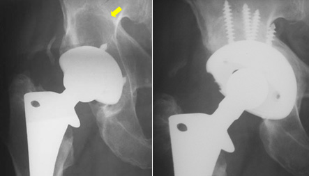 Wear of the Hip Prosthesis