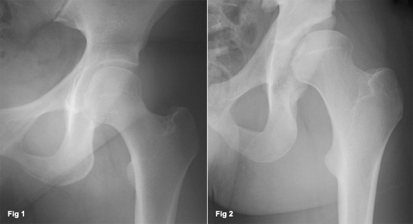 Acetabular dysplasia requiring PAO surgery (Periacetabular Osteotomy)