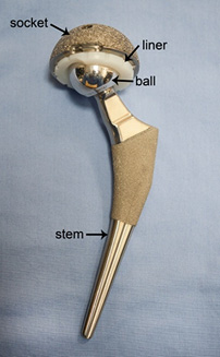 Total Hip Implant