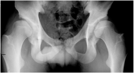 Acetabular dysplasia (shallow socket) of both hips