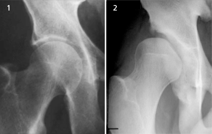Human hip dysplasia, dysplastic hip with a shallow socket and unstable femoral head