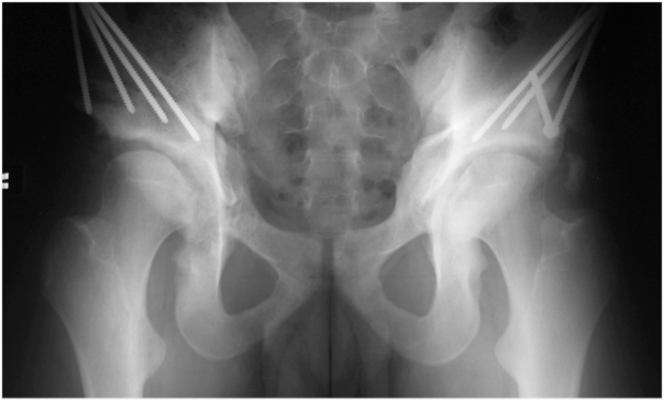 PAO surgery to correct acetabular dysplasia (shallow socket) of both hips