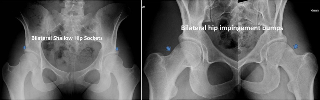 Hip dysplasia in college golfer preop PAO