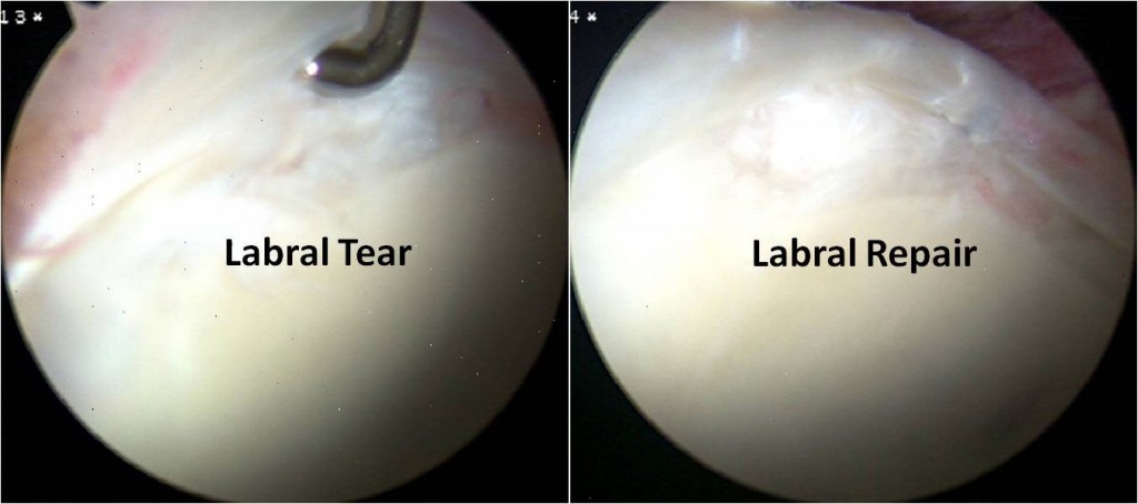 Labral tear labral repair in college golfer
