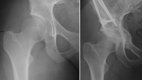 Acetabular dysplasia and PAO surgery post-op five years later